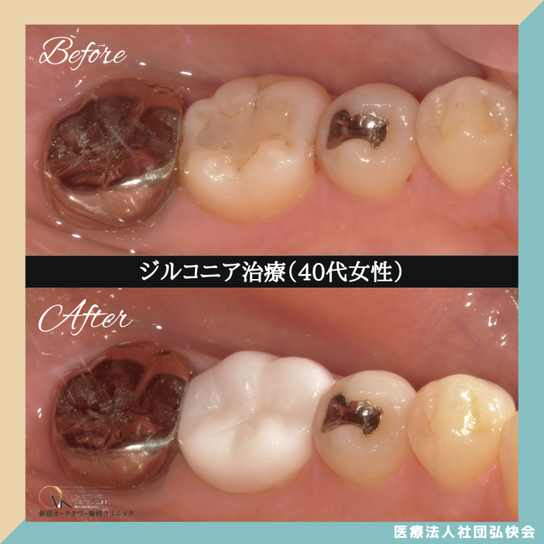 症例のご紹介81：ジルコニア治療（40代女性）