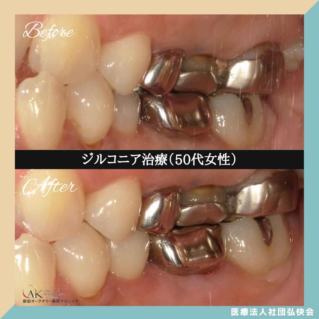 症例のご紹介92：セラミック治療（50代女性）
