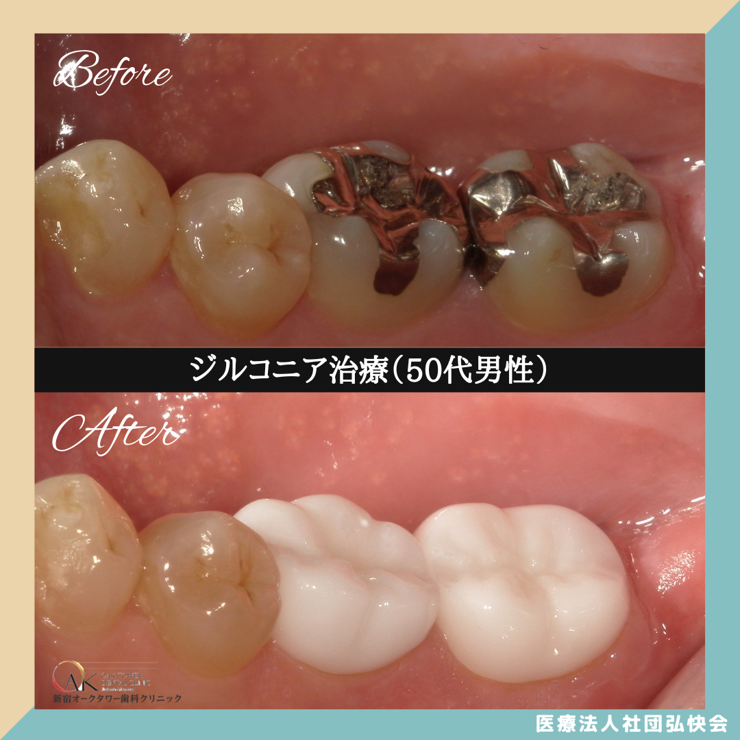 症例のご紹介93：ジルコニア治療（50代男性）