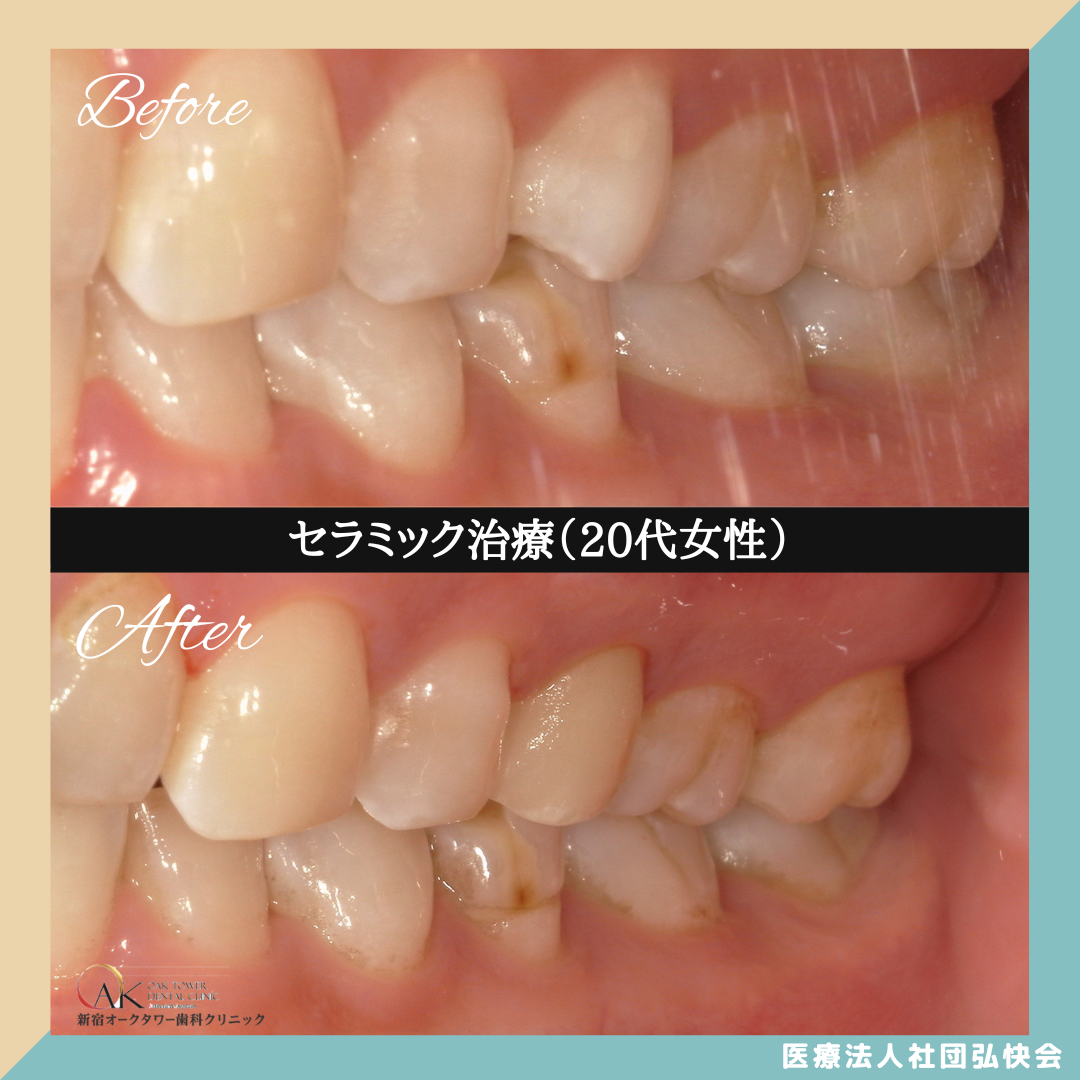 症例のご紹介94：セラミック治療（20代女性）