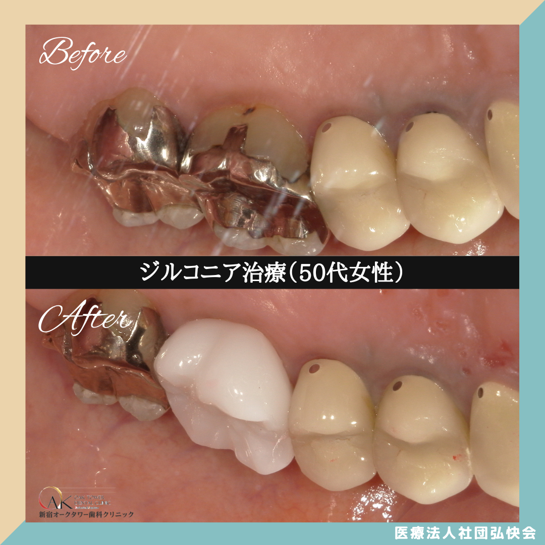 症例のご紹介95：ジルコニア治療（50代女性）