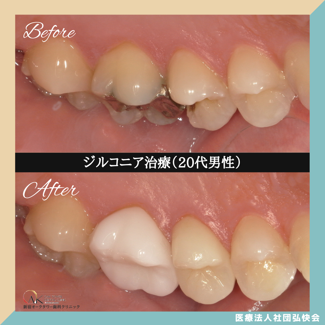 症例のご紹介96：ジルコニア治療（20代男性）