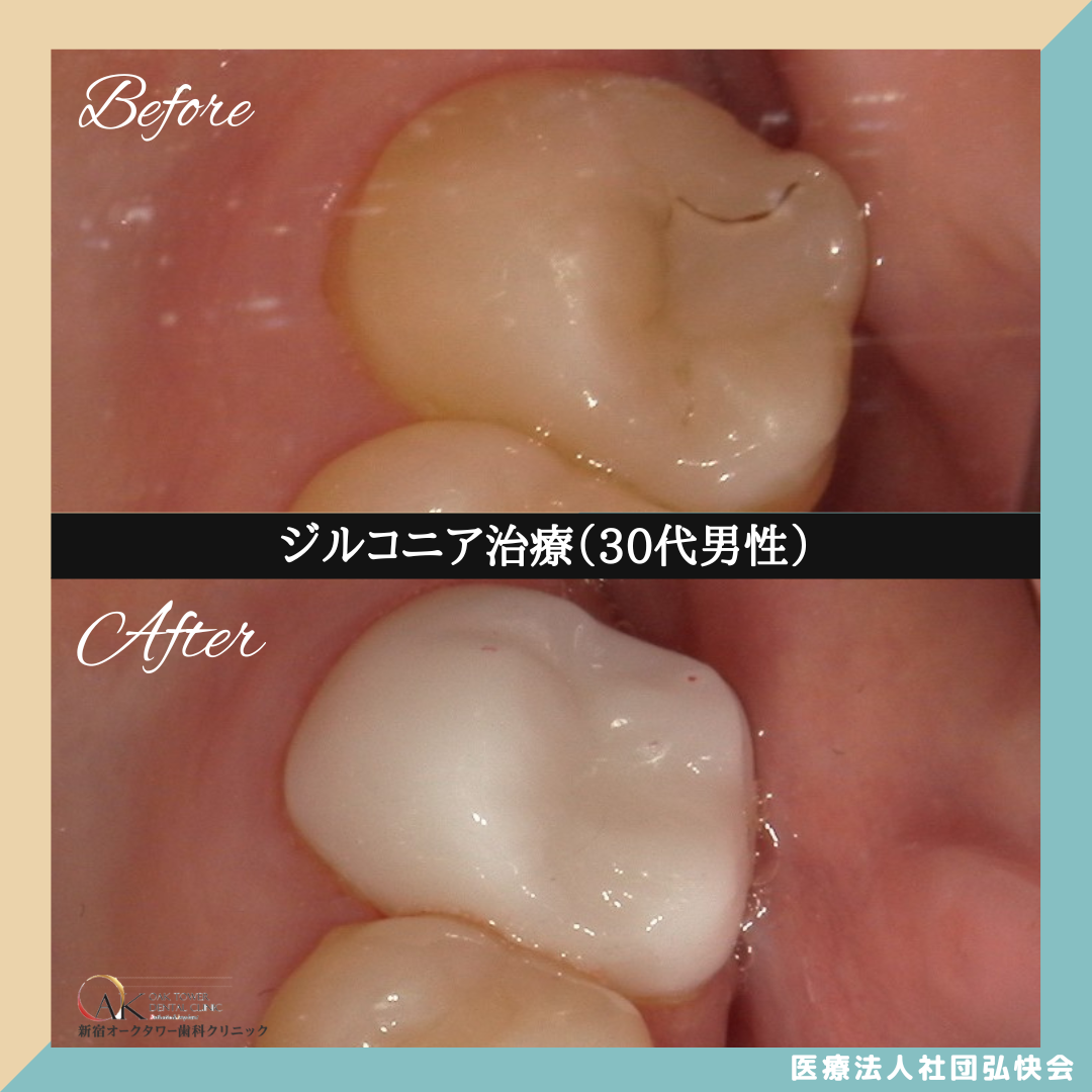症例のご紹介97：ジルコニア治療（30代男性）